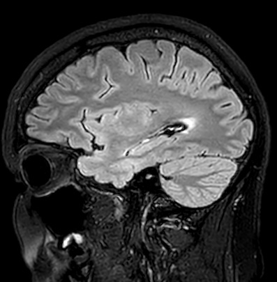 Cerebral arteriovenous malformation (Radiopaedia 74411-85746 Sagittal FLAIR 30).jpg