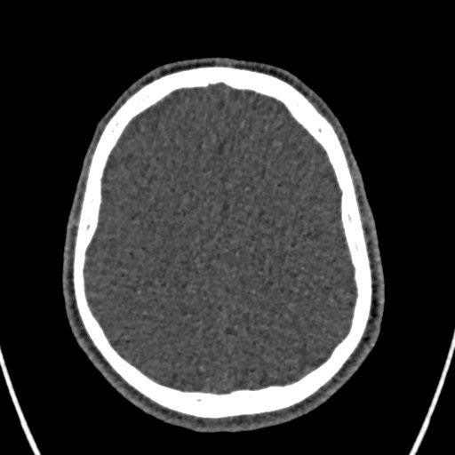 Cerebral arteriovenous malformation (Radiopaedia 78188-90746 Axial non-contrast 132).jpg