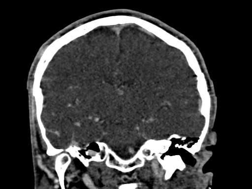 Cerebral arteriovenous malformation (Radiopaedia 78188-90746 Coronal C+ delayed 62).jpg