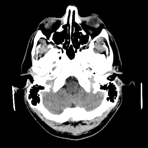 Cerebral arteriovenous malformation (Spetzler-Martin grade 2) (Radiopaedia 41262-44076 Axial non-contrast 11).png