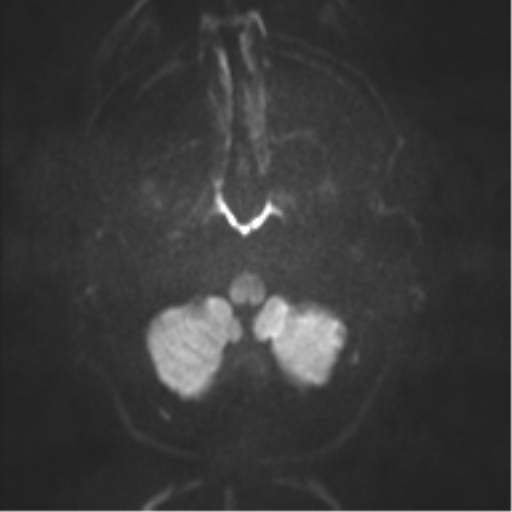 File:Cerebral arteriovenous malformation - huge (Radiopaedia 35734-37272 Axial DWI 26).png