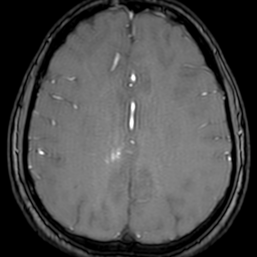Cerebral arteriovenous malformation at posterior body of corpus callosum (Radiopaedia 74111-84925 Axial MRA 151).jpg