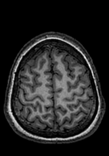 Cerebral arteriovenous malformation at posterior body of corpus callosum (Radiopaedia 74111-84925 Axial T1 40).jpg