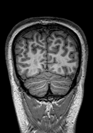 Cerebral arteriovenous malformation at posterior body of corpus callosum (Radiopaedia 74111-84925 Coronal T1 299).jpg