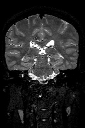Cerebral arteriovenous malformation at posterior body of corpus callosum (Radiopaedia 74111-84925 Coronal T2 106).jpg
