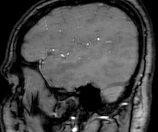 Cerebral arteriovenous malformation at posterior body of corpus callosum (Radiopaedia 74111-84925 J 51).jpg