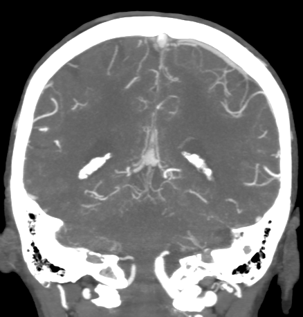 Cerebral arteriovenous malformation with lobar hemorrhage (Radiopaedia 44725-48511 B 39).png