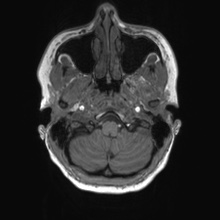 Cerebral cavernous venous malformation (Radiopaedia 70008-80021 Axial T1 7).jpg