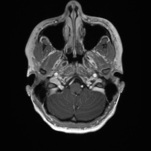 Cerebral cavernous venous malformation (Radiopaedia 70008-80021 Axial T1 C+ 7).jpg
