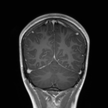 Cerebral cavernous venous malformation (Radiopaedia 70008-80021 Coronal T1 C+ 17).jpg