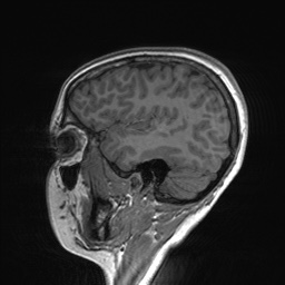 File:Cerebral cavernous venous malformation (Radiopaedia 70008-80021 Sagittal T1 58).jpg
