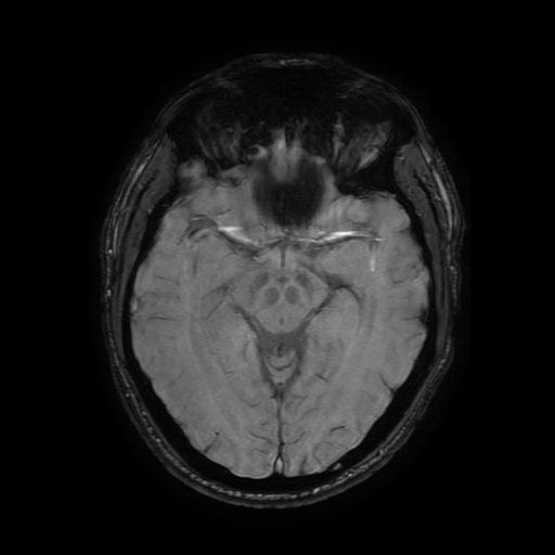 Cerebral cavernous venous malformation (Zabramski type II) (Radiopaedia 85511-101198 Axial SWI 57).jpg
