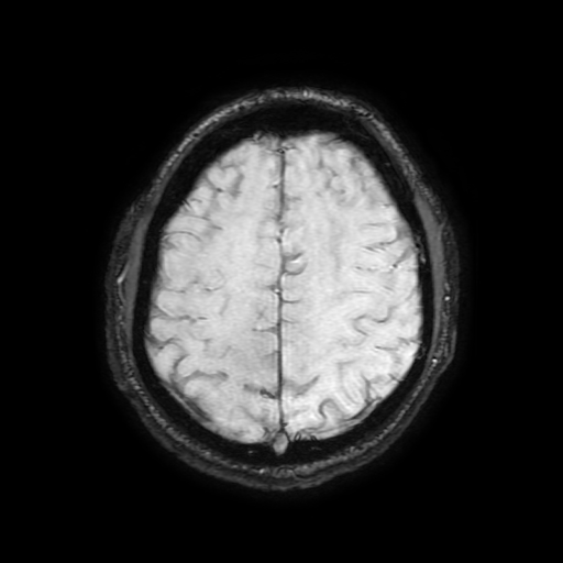 Cerebral cavernous venous malformation (Zabramski type II) (Radiopaedia 85511-101198 Axial SWI 92).jpg