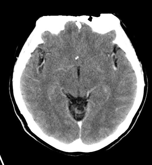 File:Cerebral cavernous venous malformations (Radiopaedia 48117-52945 Axial C+ delayed 16).png