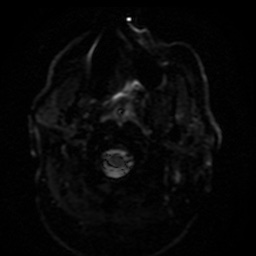 Cerebral embolic infarcts (embolic shower) (Radiopaedia 49837-55108 Axial DWI 48).jpg