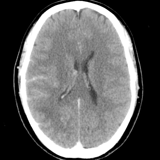 File:Cerebral hemorrhage secondary to arteriovenous malformation (Radiopaedia 33497-34561 B 32).png