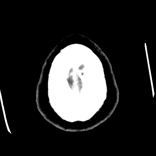 Cerebral hemorrhage secondary to arteriovenous malformation (Radiopaedia 33497-34561 B 51).png