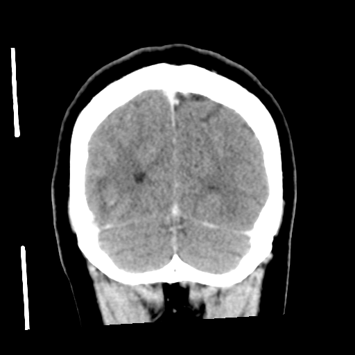 Cerebral hemorrhage secondary to arteriovenous malformation (Radiopaedia 33497-34561 C 56).png