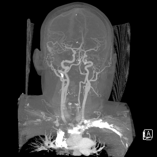 File:Cerebral hemorrhage secondary to arteriovenous malformation (Radiopaedia 33497-34571 A 21).png