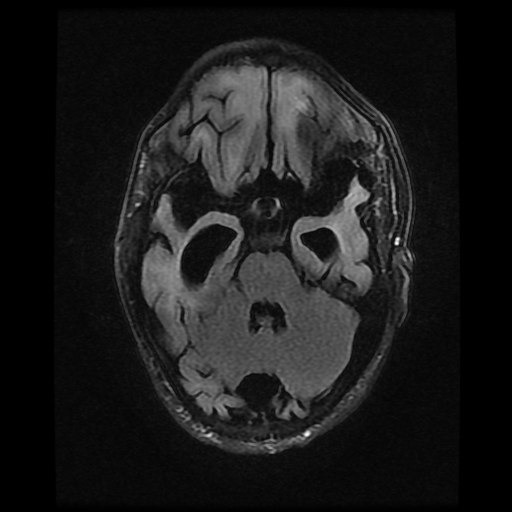 File:Cerebral manifestations of mucopolysaccharidosis type I (Radiopaedia 59171-66487 Axial FLAIR 6).jpg
