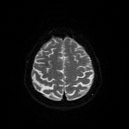 Cerebral metastases - melanoma (Radiopaedia 80972-94522 Axial DWI 88).jpg