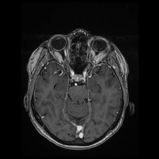 File:Cerebral metastases - melanoma (Radiopaedia 80972-94522 Axial T1 C+ 45).jpg