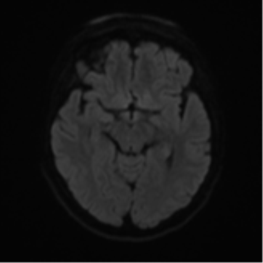 Cerebral metastases mimicking abscesses (Radiopaedia 45841-50131 Axial DWI 41).png