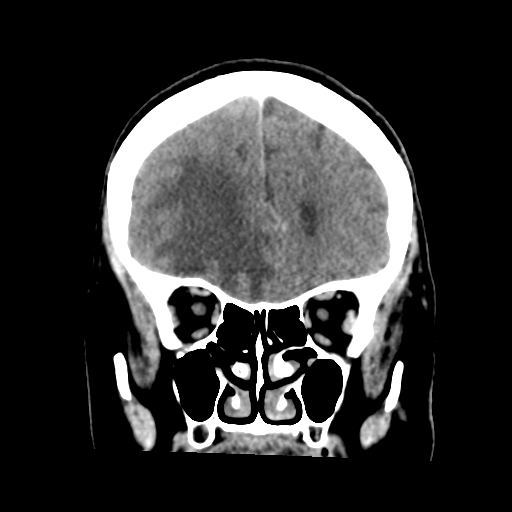 Cerebral metastasis to basal ganglia (Radiopaedia 81568-95412 Coronal C+ delayed 18).png