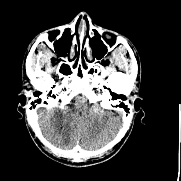 Cerebral toxoplasmosis (Radiopaedia 53993-60131 Axial non-contrast 17).jpg