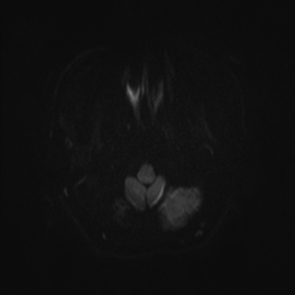 Cerebral toxoplasmosis (Radiopaedia 53993-60132 Axial DWI 29).jpg
