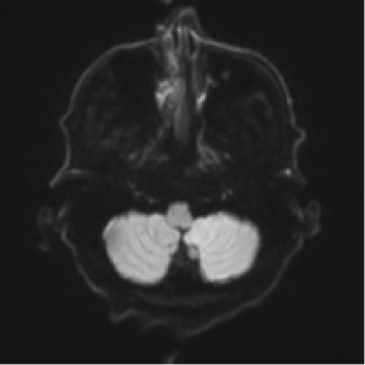 Cerebral toxoplasmosis (Radiopaedia 54575-60804 Axial DWI 39).png