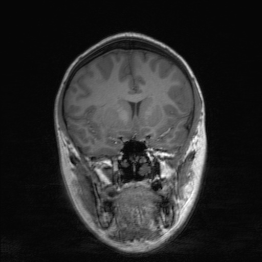 Cerebral tuberculosis with dural sinus invasion (Radiopaedia 60353-68090 Coronal T1 74).jpg