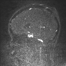 Cerebral tuberculosis with dural sinus invasion (Radiopaedia 60353-68090 Sagittal MRV 82).jpg
