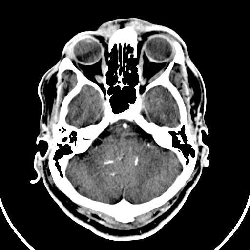 Cerebral venous angioma (Radiopaedia 69959-79977 B 9).jpg