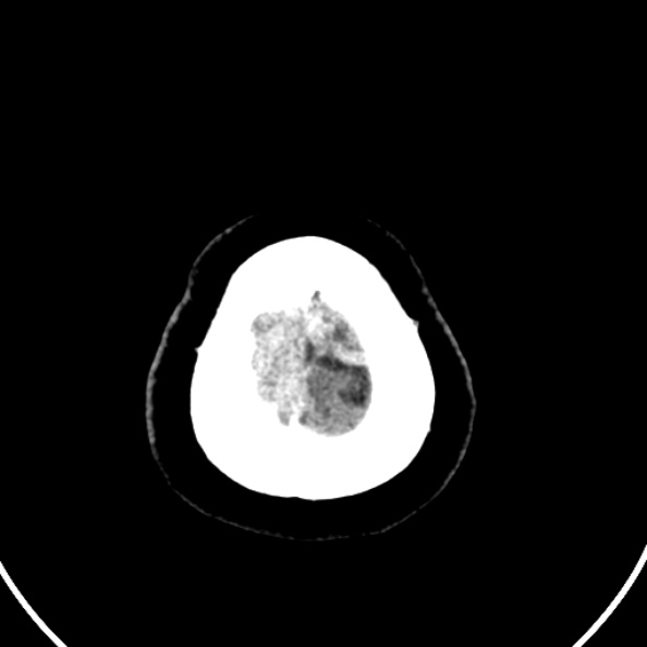 Cerebral venous hemorrhagic infarct from venous sinus thrombosis (Radiopaedia 55433-61883 Axial C+ delayed 11).jpg