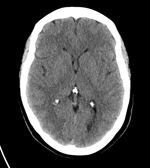 File:Cerebral venous infarct related to dural venous sinus thromboses (Radiopaedia 35292-36804 Axial non-contrast 15).png