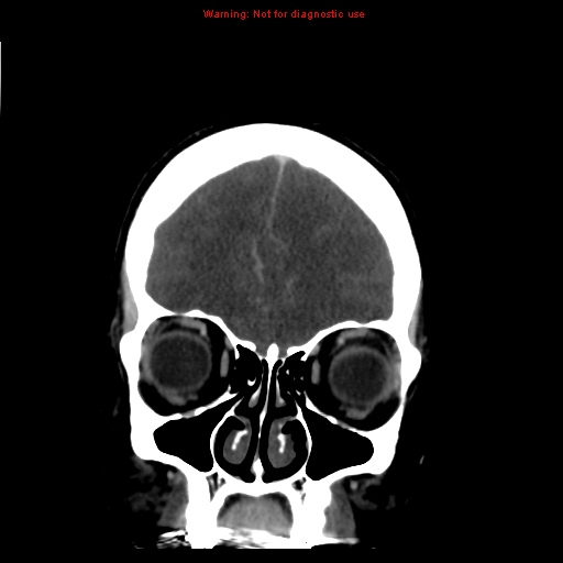 Cerebral venous infarction (Radiopaedia 12404-20735 B 15).jpg