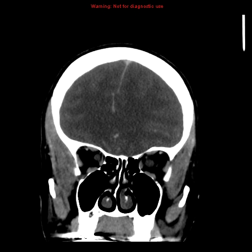 Cerebral venous infarction (Radiopaedia 12404-20735 B 21).jpg