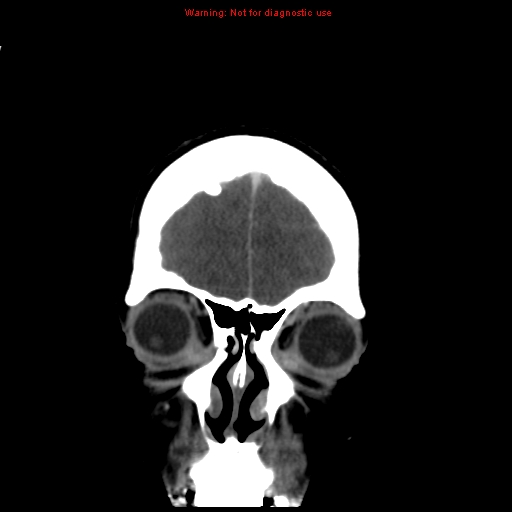 Cerebral venous infarction (Radiopaedia 12404-20735 B 9).jpg