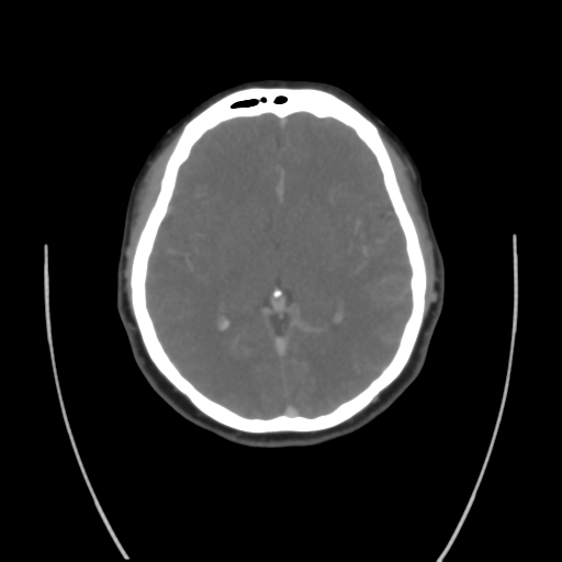Cerebral venous infarction due to transverse sinus thrombosis (Radiopaedia 34688-36120 Coronal 1).png
