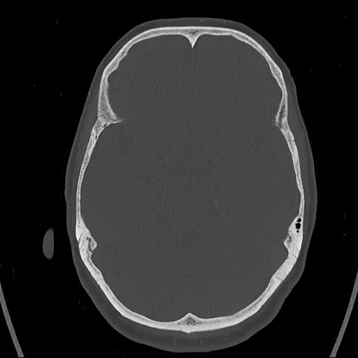 Cerebral venous infarction with hemorrhage (Radiopaedia 65343-74381 Axial bone window 56).jpg