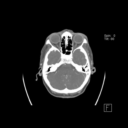 Cerebral venous infarction with hemorrhage (Radiopaedia 65343-74396 A 25).jpg
