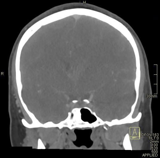 Cerebral venous sinus thrombosis (Radiopaedia 91329-108965 Coronal venogram 40).jpg