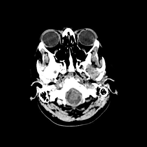 Cerebral venous throbmosis - hemorrhagic venous infarction (Radiopaedia 87318-103613 Axial non-contrast 16).jpg