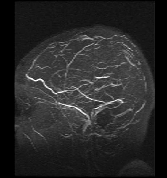 File:Cerebral venous thrombosis (Radiopaedia 11289-11653 None 1).jpg