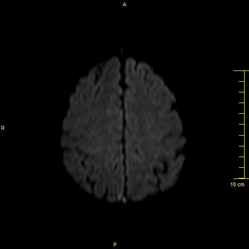 File:Cerebral venous thrombosis (Radiopaedia 23288-23351 Axial DWI 33).JPG