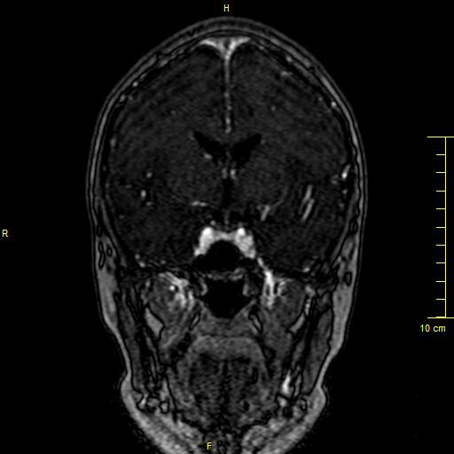 Cerebral venous thrombosis (Radiopaedia 23288-23351 MRV 58).JPG