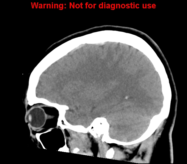 File:Cerebral venous thrombosis (Radiopaedia 37224-38992 B 10).jpg