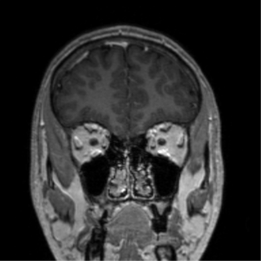 Cerebral venous thrombosis (Radiopaedia 38392-40469 Coronal T1 C+ 72).png