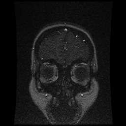 Cerebral venous thrombosis - ulcerative colitis (Radiopaedia 66049-75219 Coronal MRV 100).jpg